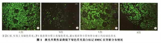 干细胞治疗26例慢性肾病患者临床疗效观察