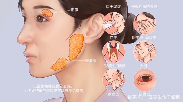 干细胞疗法在干燥综合征中的作用机制与应用前景