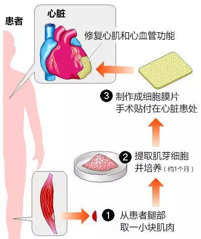 用自体干细胞体外培养一个器官，自身出现问题直接置换，可以吗？