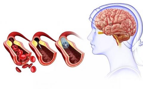 64例干细胞移植联合高压氧成为改善脑卒中后遗症的新途径