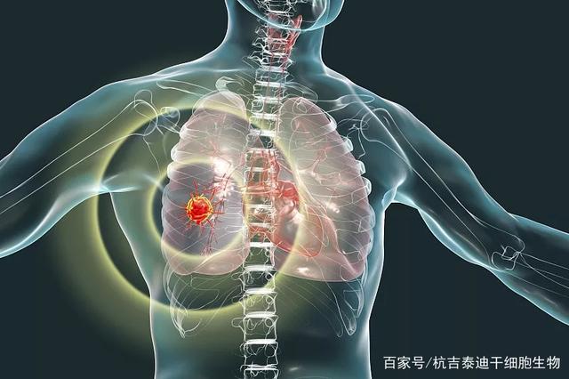 全球首个治疗慢阻肺的干细胞药品获批，即将启动II期临床