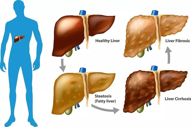 临床案例：干细胞治疗肝病的基础和临床研究，显示其效果显著