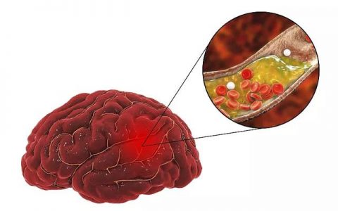 新发现，干细胞治疗缺血性脑卒中的多重作用机制