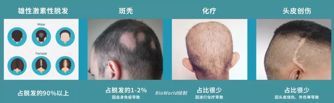 用iPS干细胞再生毛囊,治疗脱发,这家初创公司获1500万美元融资 用iPS干细胞再生毛囊,治疗脱发,这家初创公司获1500万美元融资