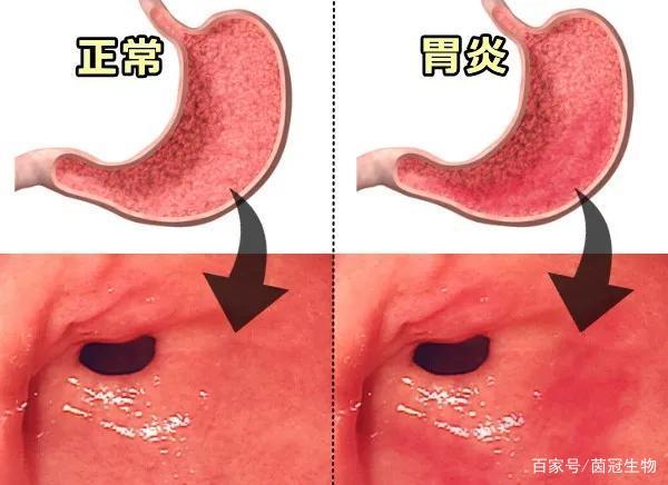 慢性胃炎反复发作？干细胞疗法有效率高达92%