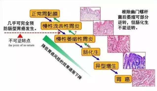 慢性胃炎反复发作？干细胞疗法有效率高达92%