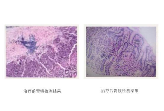 慢性胃炎反复发作？干细胞疗法有效率高达92%