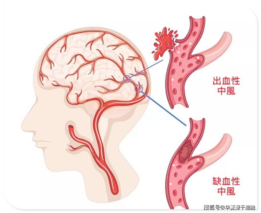 心血管疾病治疗新思路，免疫细胞疗法是如何调节血流的？