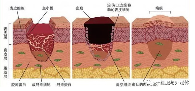 间充质干细胞外泌体在皮肤再生中的作用