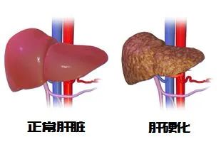 【招募】武汉大学人民医院|人脐带源间充质干细胞治疗乙型病毒性肝炎肝硬化（代偿期）随机双盲对照临床研究