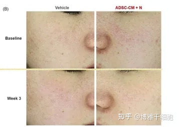 双盲、随机对双盲、照研究证实:脂肪干细胞上清液可减少皮肤皱纹 双盲、随机对双盲、照研究证实:脂肪干细胞上清液可减少皮肤皱纹