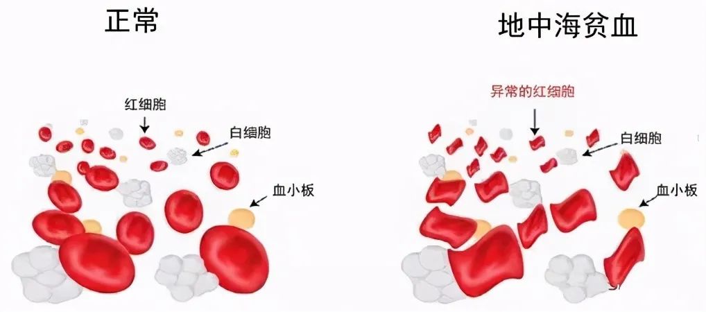 【招募】广西医科大学第一附属医院|经γ珠蛋白重激活的自体造血干细胞移植治疗重型β地中海贫血安全性及有效性的临床研究