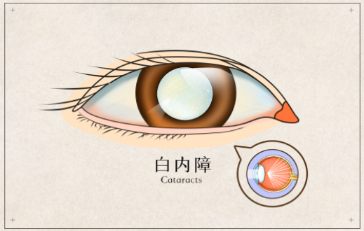 干细胞让先天性白内障患儿长出新晶状体