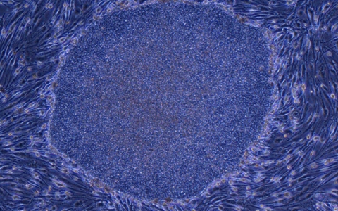 iPSC-NK细胞治疗卵巢癌开始临床实验