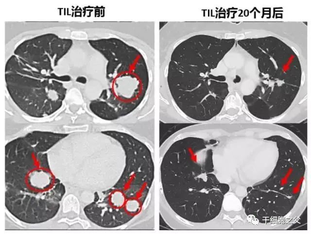 晚期癌症患者成功治愈并幸存9年，TIL免疫细胞疗法成为“科技抗癌重拳”！