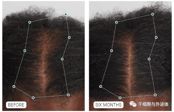 Nutrafol推出首款植物外泌体头发精华素，能让头发看起来更浓密