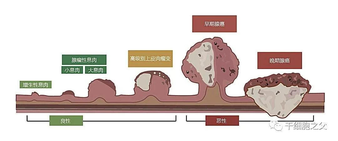 告别化疗之苦，细胞免疫疗法让直肠癌患者重获新生！