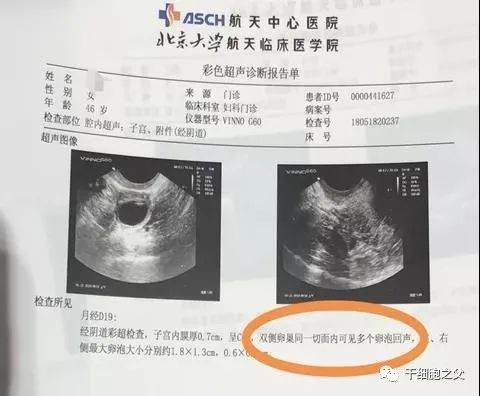 卵巢老1岁，女人老10岁，干细胞如何化解当下女性卵巢危机？
