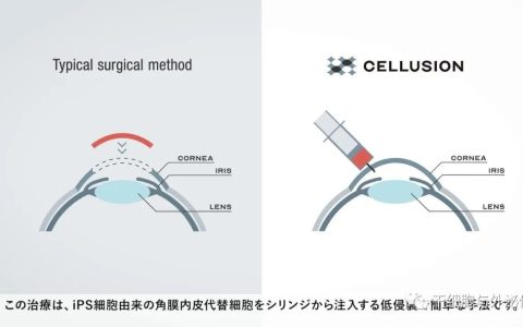 Cellusion筹集11亿日元以推进iPS细胞衍生角膜细胞代替角膜移植，开展临床试验