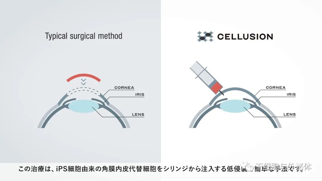 Cellusion筹集11亿日元以推进iPS细胞衍生角膜细胞代替角膜移植，开展临床试验