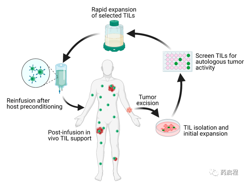 实体瘤的TIL疗法：个性化护理标准的途径