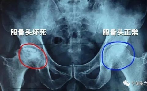 干细胞疗法针对65例股骨头坏死的案例报告