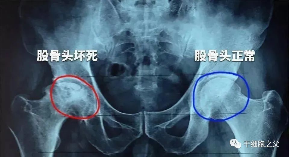 干细胞疗法针对65例股骨头坏死的案例报告