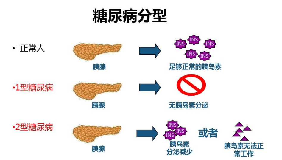 【科学普及】间充质干细胞与糖尿病的治疗