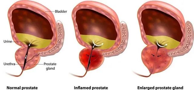 过半男性都有前列腺疾病？干细胞拯救你的生命“腺”