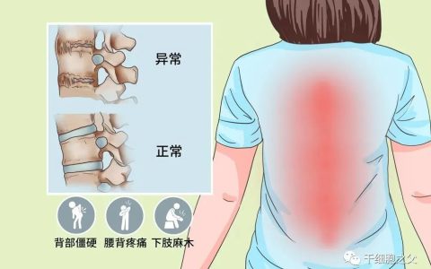 间充质干细胞治疗强直性脊柱炎36例临床分析