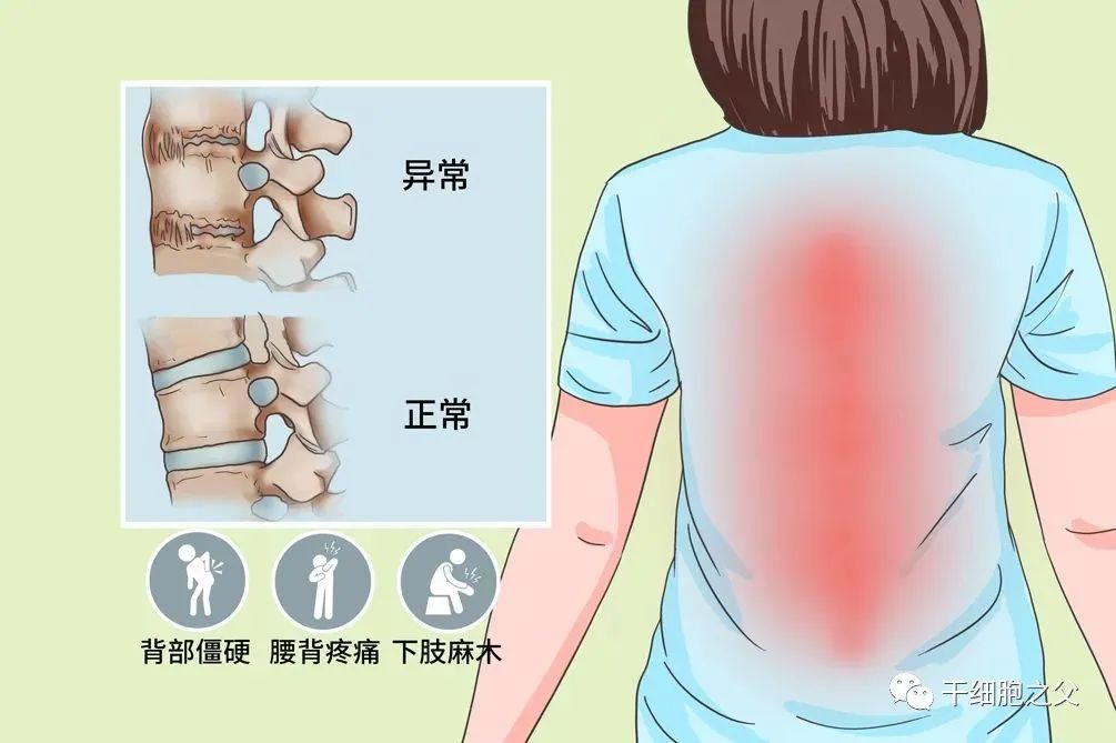 间充质干细胞治疗强直性脊柱炎36例临床分析