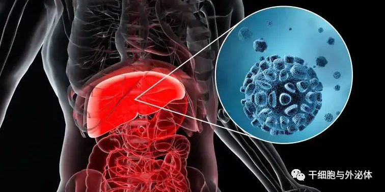 肝病诊治 | 探索4项细胞外囊泡与肝病研究进展