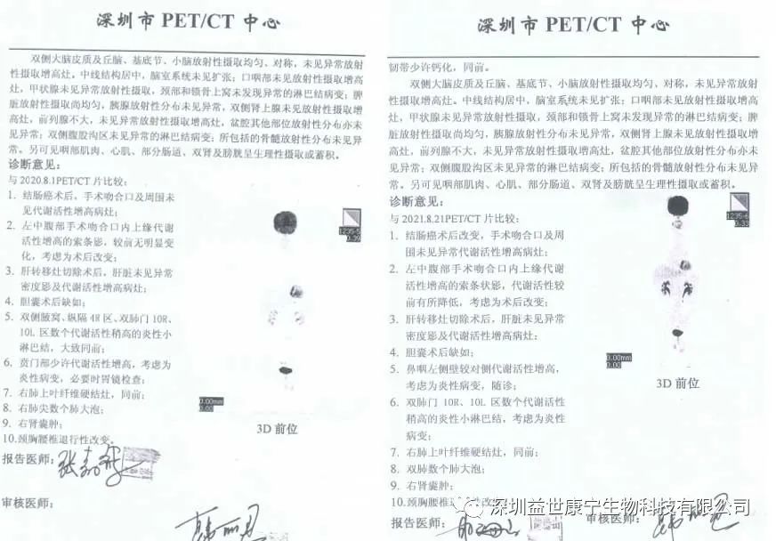 结直肠癌接受ACTL靶向性细胞免疫治疗检查流程及案例