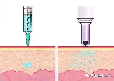 无针注射 | 外泌体改善老化皮肤中的胶原蛋白生成