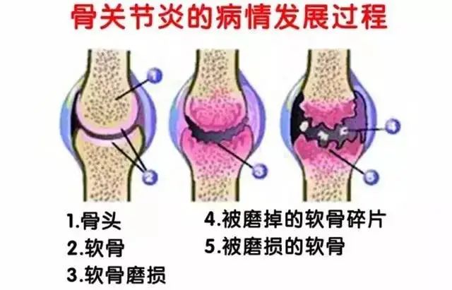 干细胞治疗世界头号致残性疾病--骨关节炎