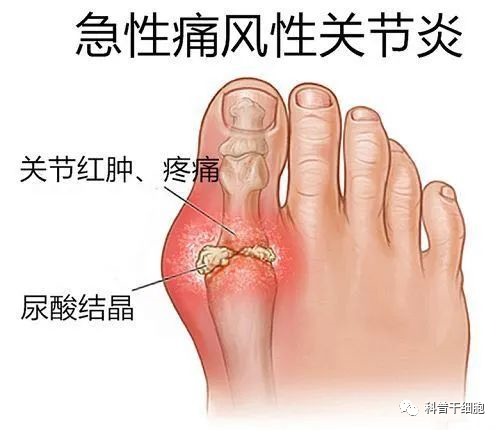 被誉为“帝王病”的痛风，到底应该怎么治？