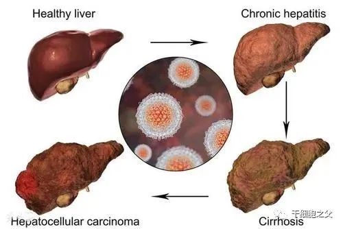 王福生院士：脐带间充质干细胞显著改善失代偿性肝硬化的肝功能，提高长期生存率