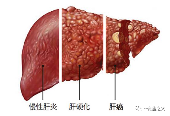 王福生院士：脐带间充质干细胞显著改善失代偿性肝硬化的肝功能，提高长期生存率