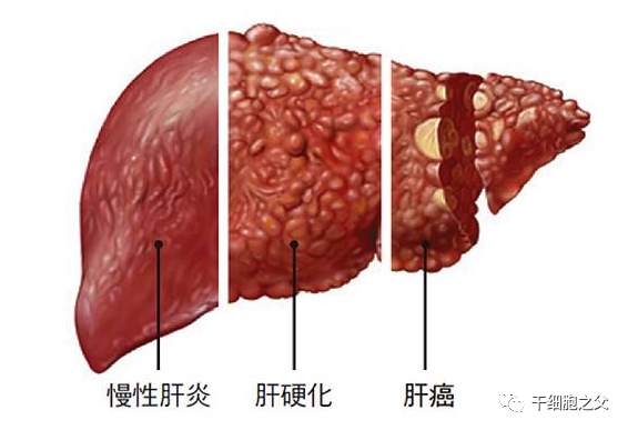 肝硬化是什么引起的图片