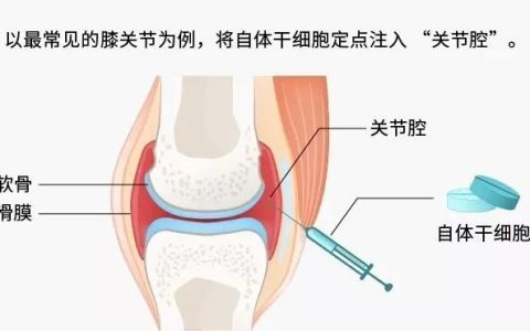 间充质干细胞在骨科疾病的应用大全