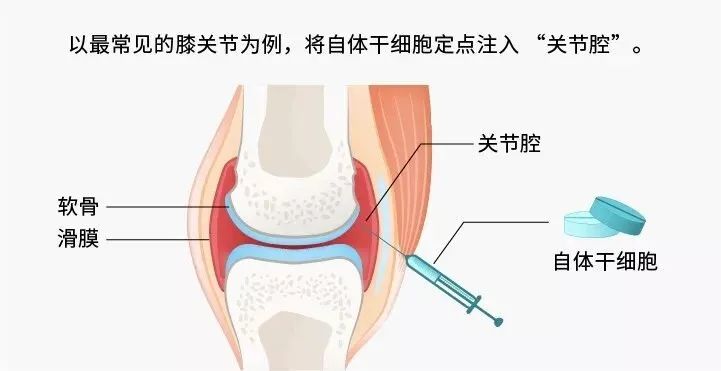 间充质干细胞在骨科疾病的应用大全