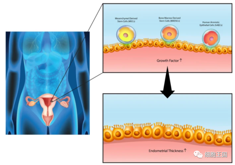 宫腔粘连综合症和薄型子宫内膜的细胞治疗