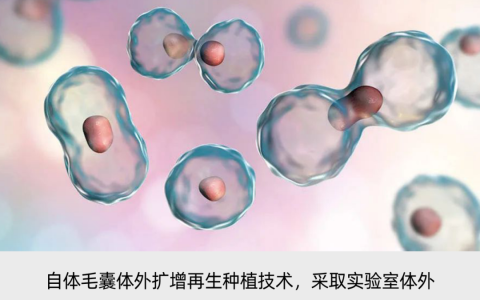 自研自体毛囊再生种植技术，「华科同济干细胞」成功临床应用大面积植发