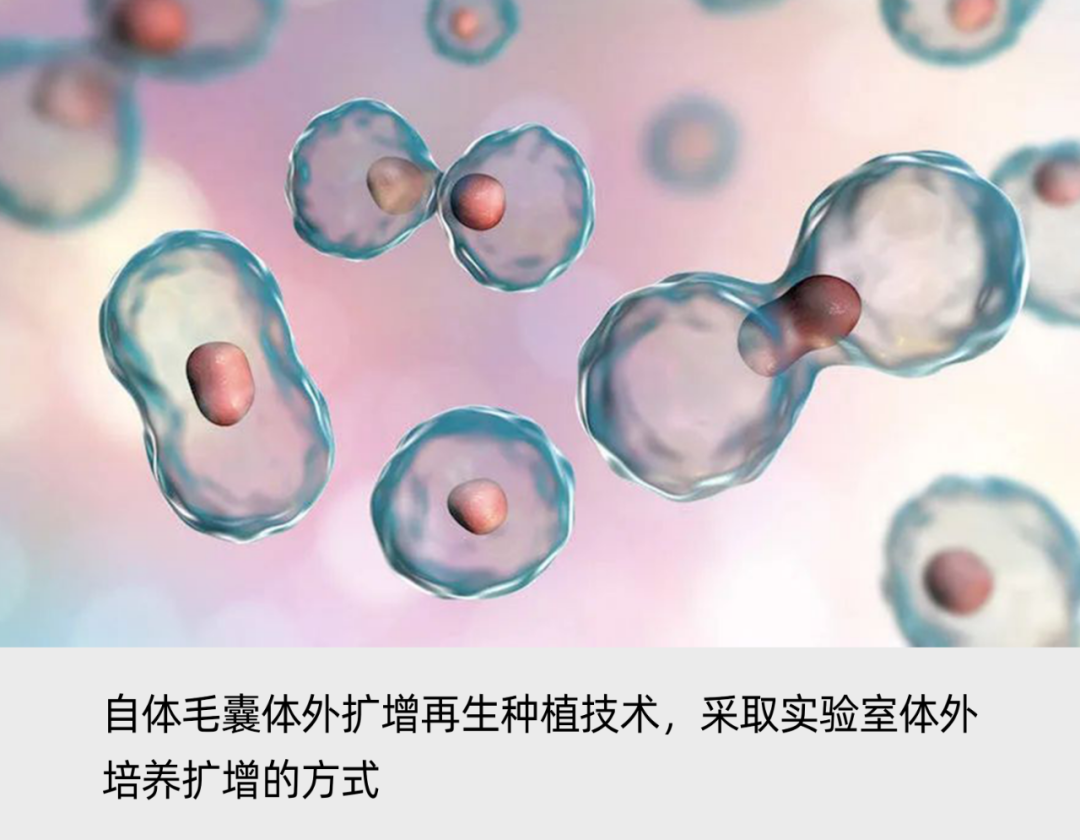 自研自体毛囊再生种植技术，「华科同济干细胞」成功临床应用大面积植发