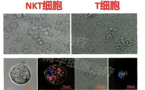 NKT、NK、T免疫细胞，谁才是肿瘤细胞的超级杀手？