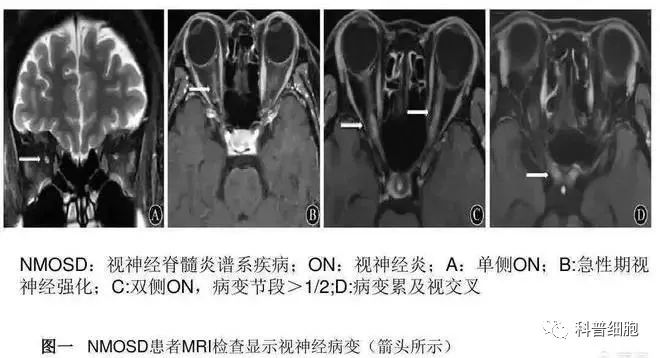 干细胞治疗神经免疫性疾病效果显著！