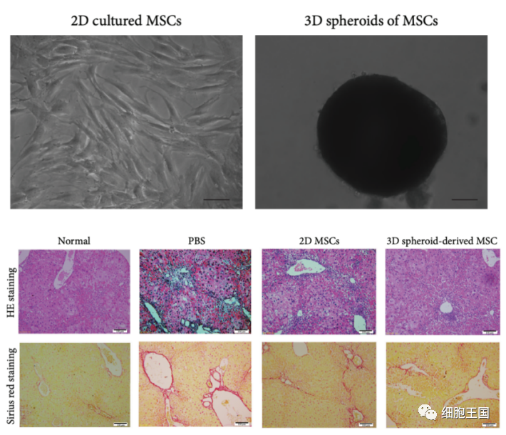 最新总结｜干细胞治疗肝纤维化/肝硬化：临床进展和治疗前景