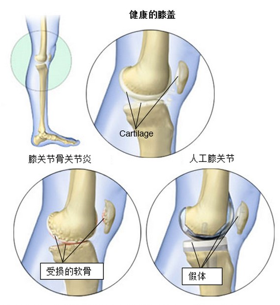 干细胞药物：退行性关节炎克星CARTISTEM