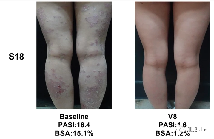 湘雅医院发布最新干细胞治疗银屑病结果，女性比男性更有效，有效率高达67%