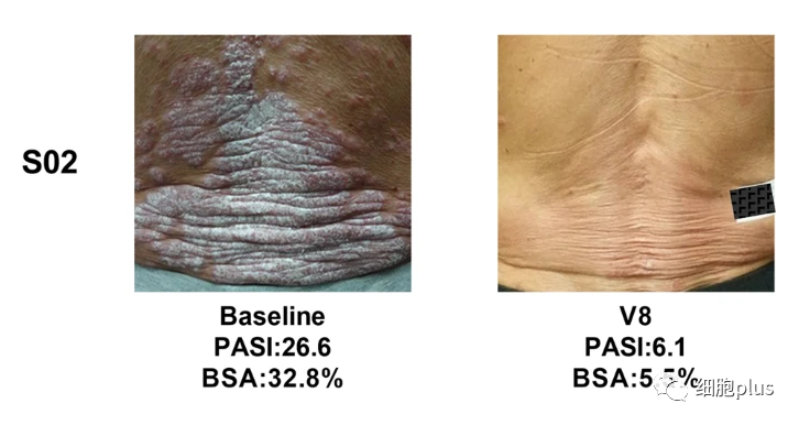 湘雅医院发布最新干细胞治疗银屑病结果，女性比男性更有效，有效率高达67%
